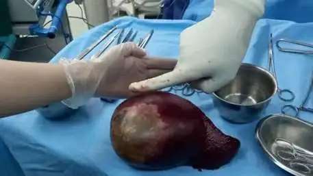  Splenectomy of a 1.5 kg spleen from a 16-year-old patient in Kosar Hospital