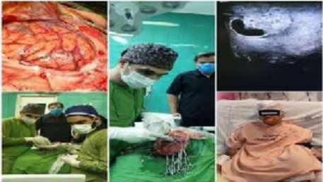  Successful surgery to remove a brain tumor with the help of an ultrasound device in Kosar Hospital
